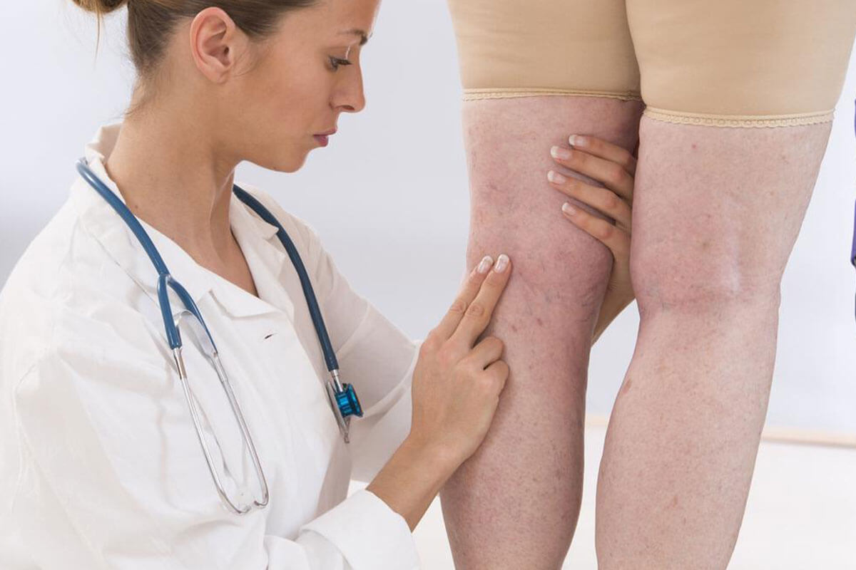 Standard Methods Used for the Treatment of Deep Vein Thrombosis